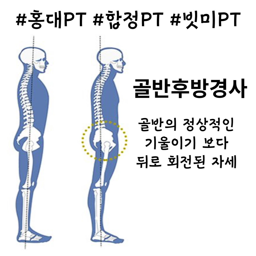  홍대PT, 합정PT, 서교동 PT 골반 후방경사 체크 및 폼롤러 스트레칭 방법 : D (빗미PT)