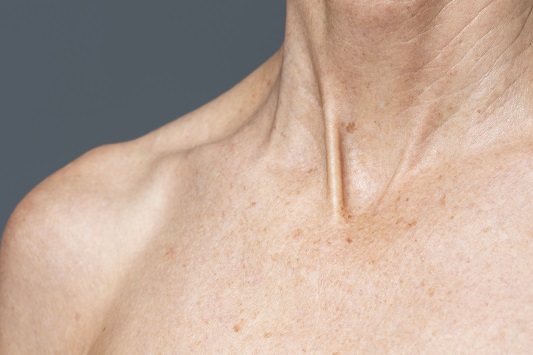 neck-Soft-fibroma