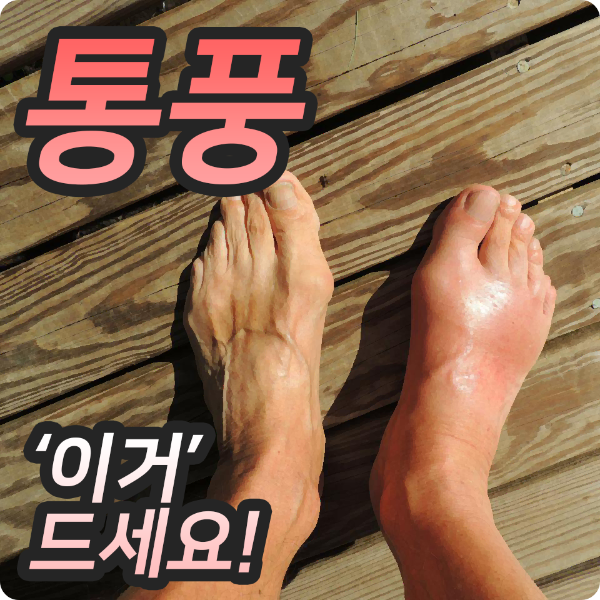  통풍 요산수치 낮추는 음식