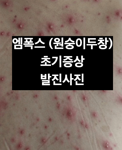 엠폭스 (원숭이두창) 초기증상 사진