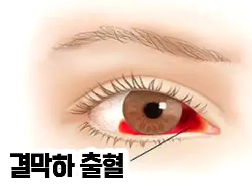 눈혈관-터지는-증상