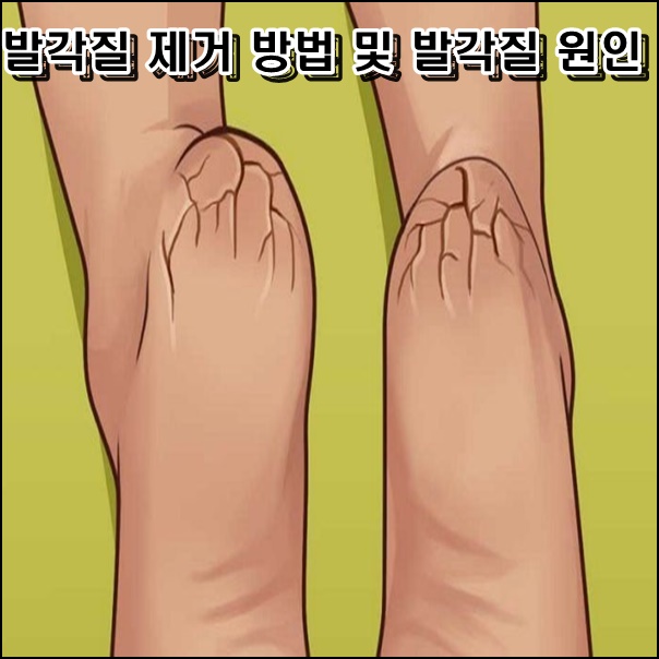  발 각질제거 방법 및 발각질 원인