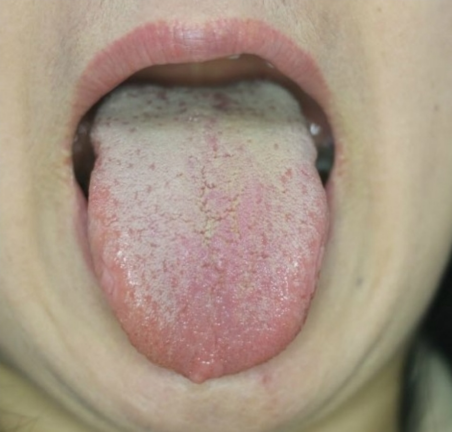 환자가 혀를 내밀어서 혀에 백태가 많이 끼어 있는 것을 확대하여 찍은 사진
