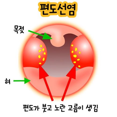 아데노이드 수술 아데노이드 비대증과 편도 비대