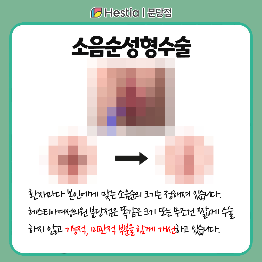 여자소음순 소음순 늘어짐 소음순성형수술 소음순성형수술 방법