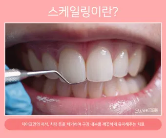 스케일링 후 양치 통증 음식_20