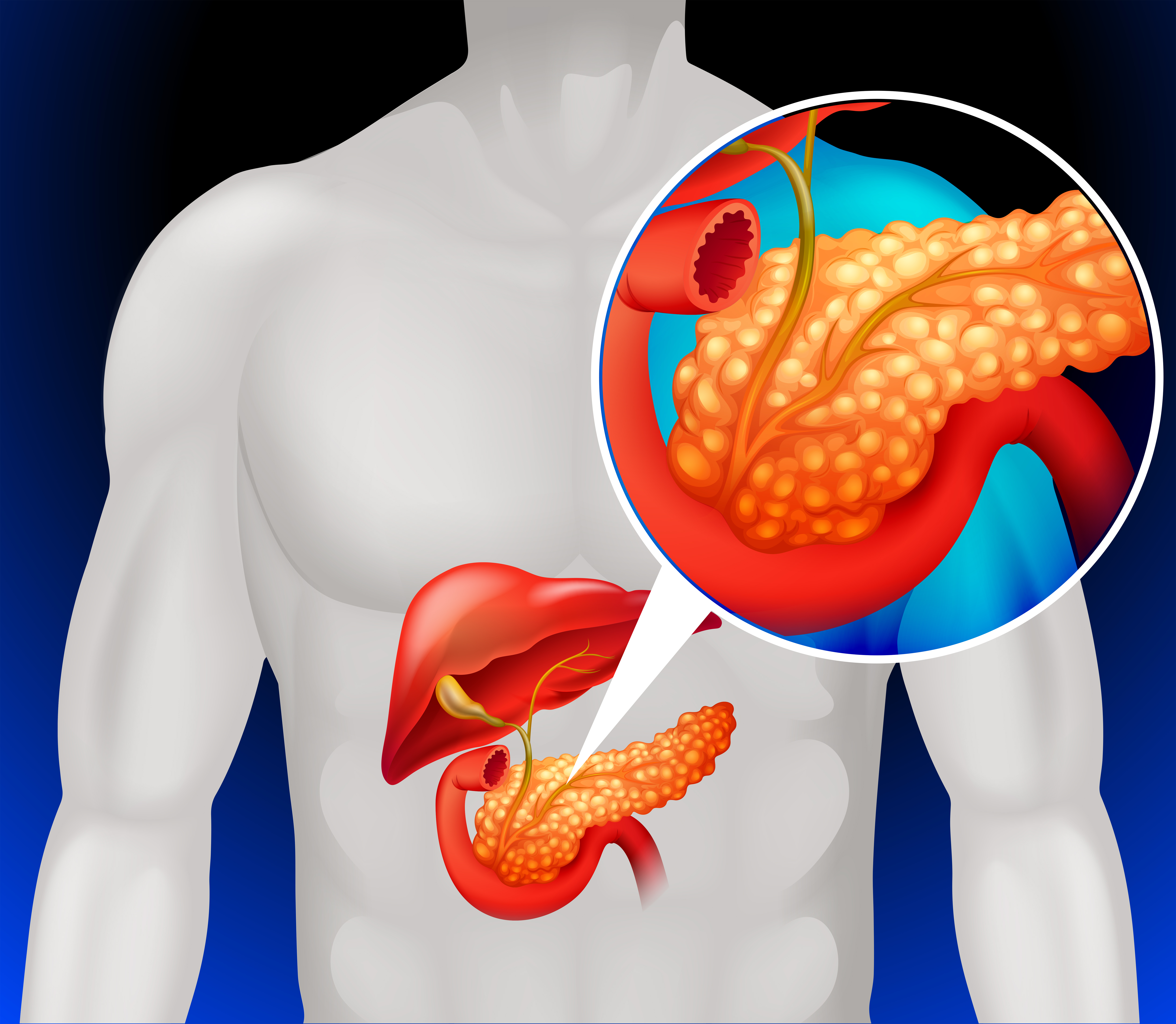  외부 감염이 아닌 자가소화, 급성 췌장염(Acute pancreatitis) 원인