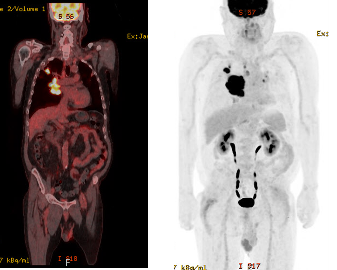 PET-CT IMAGE 사진