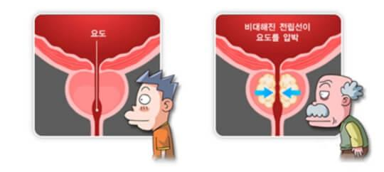 전립선 건강 중요성 사진