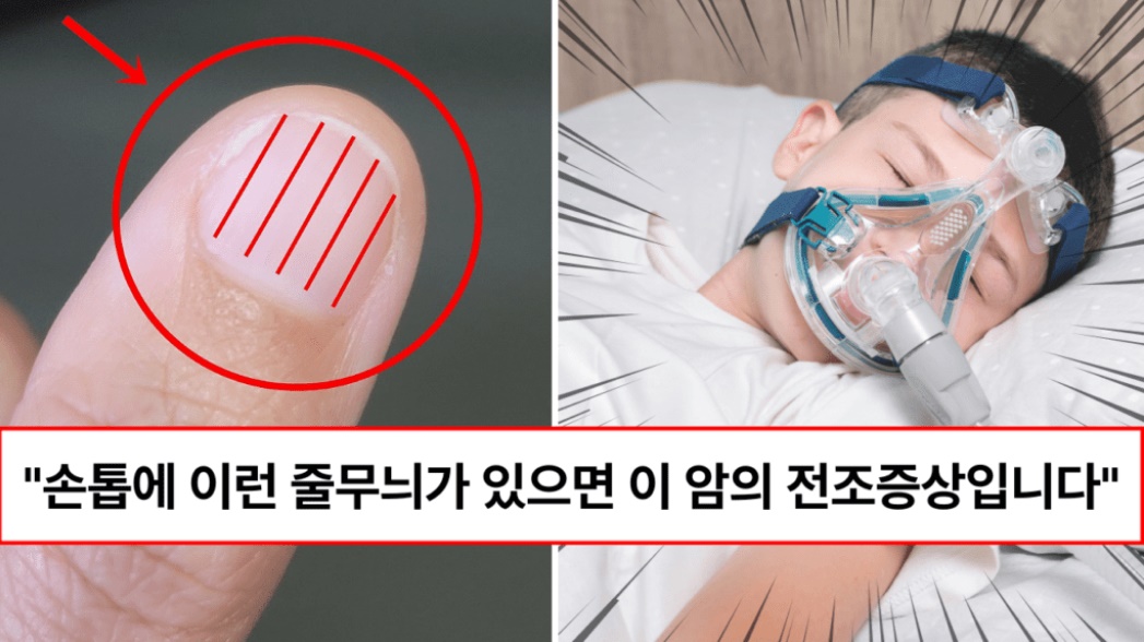 “손톱에 이런것이 보이면 바로 병원가세요” 깨진손톱, 가로줄무늬, 세로줄무늬 등 손톱만 봐도 알 수 있는 7가지 질병 총정리 “손톱에 이런것이 보이면 바로 병원가세요” 깨진손톱, 가로줄무늬, 세로줄무늬 등 손톱만 봐도 알 수 있는 7가지 질병 총정리