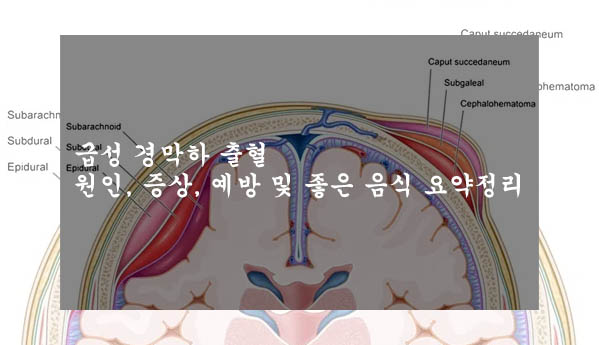  급성 경막하 출혈 원인, 증상, 예방 및 좋은 음식 요약정리