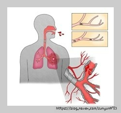 호흡기 질환: 객혈- 종류, 원인, 증상, 진단방법, 치료방법.