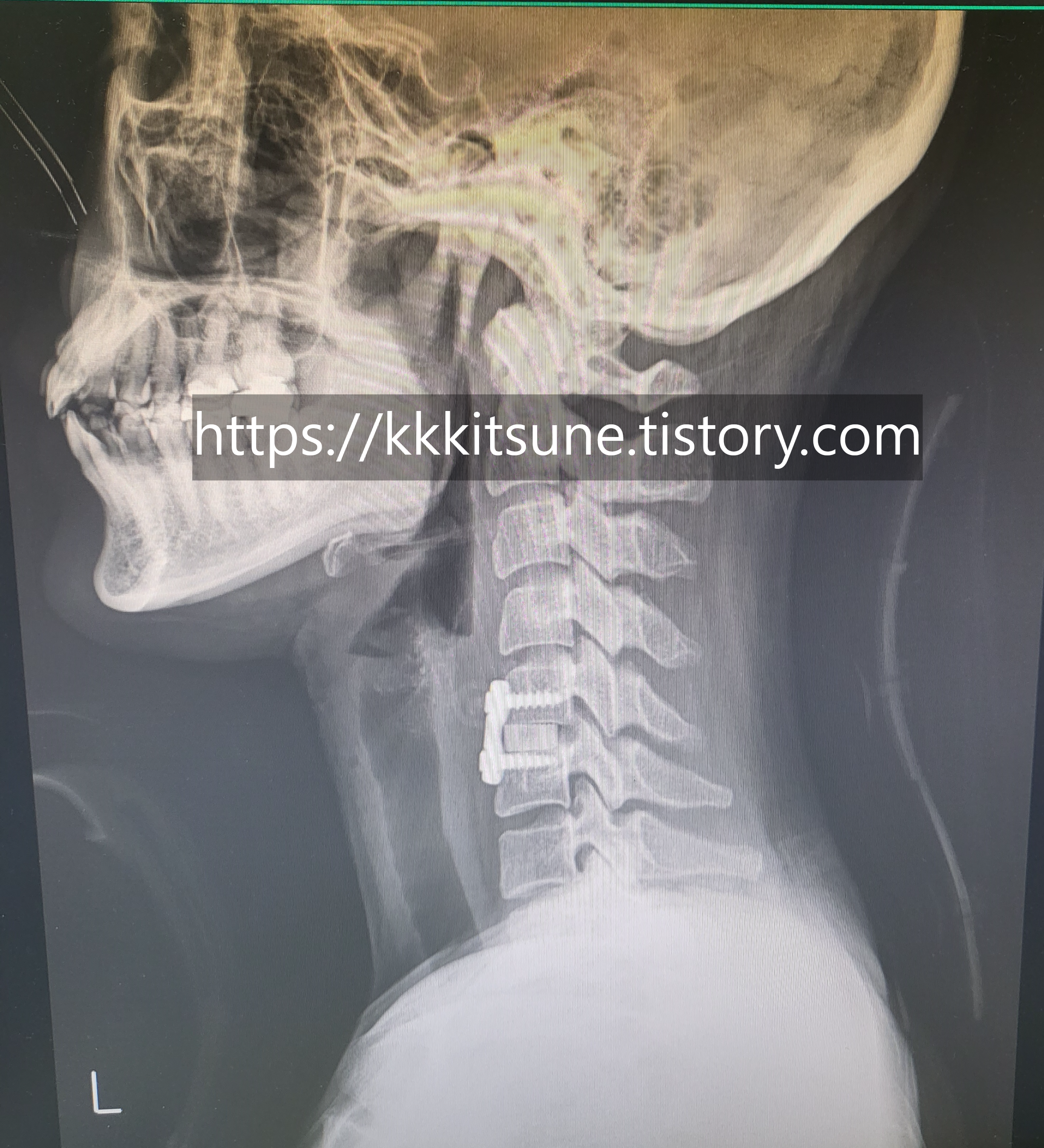 목 디스크 수술 후 엑스레이