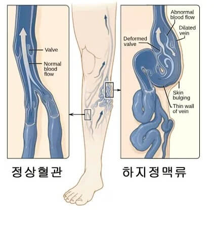 하지정맥류