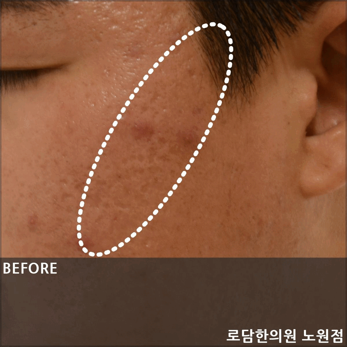 노원 여드름 흉터 피부 복원은 로담한의원 새살침으로 치료를