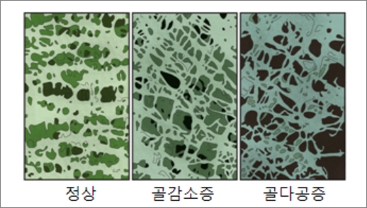 골밀도 비교