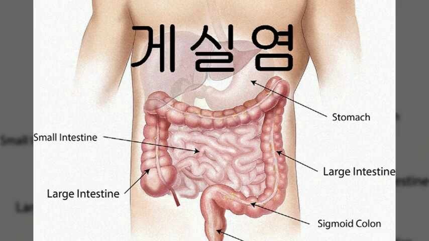 게실염
