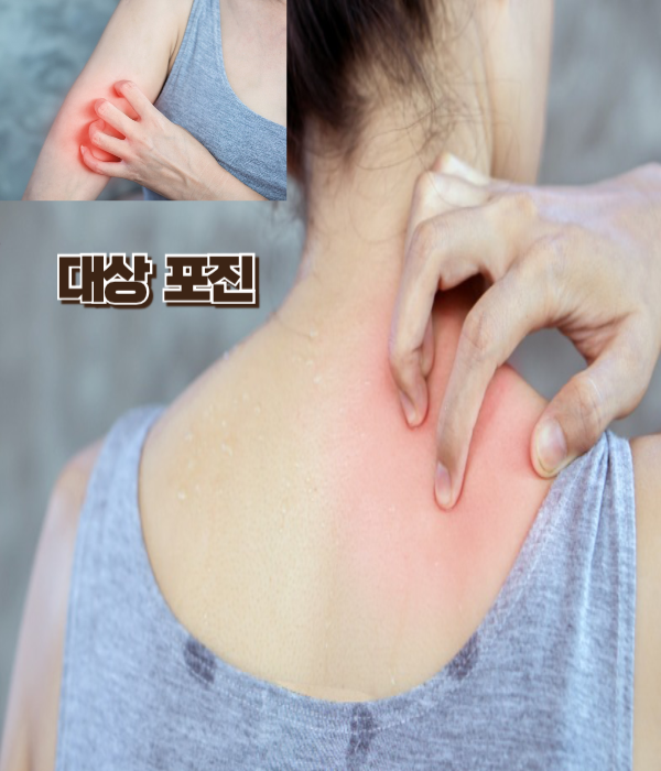 대상-포진