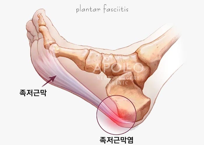 발바닥 통증부위&amp;#44; 발바닥 혈자리&amp;#44; 발바닥 통증&amp;#44; 발바닥 지압점그리기&amp;#44; 발바닥 저림증상&amp;#44; 발바닥 굳은살 원인&amp;#44; 발바닥 파스 효과&amp;#44; 발바닥 핫팩&amp;#44; 발바닥 티눈 없내는 법&amp;#44; 발바닥 지압매트&amp;#44; 발바닥 무좀&amp;#44; 발바닥 통증 치료&amp;#44; 발바닥 통증 스트레칭&amp;#44; 왼쪽 발바닥 통증&amp;#44; 오른쪽 발바닥 통증&amp;#44; 허리 디스크 발바닥 통증