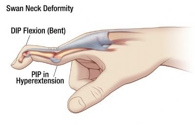 swan neck deformity