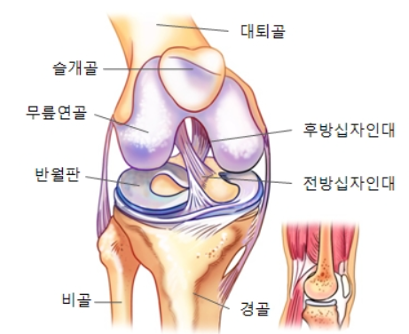 십자인대 파열