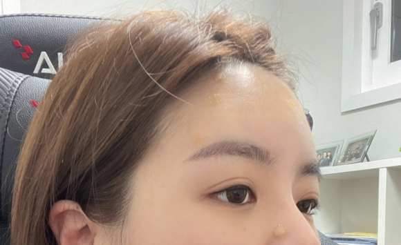 이마필러잘하는곳 후기! 4