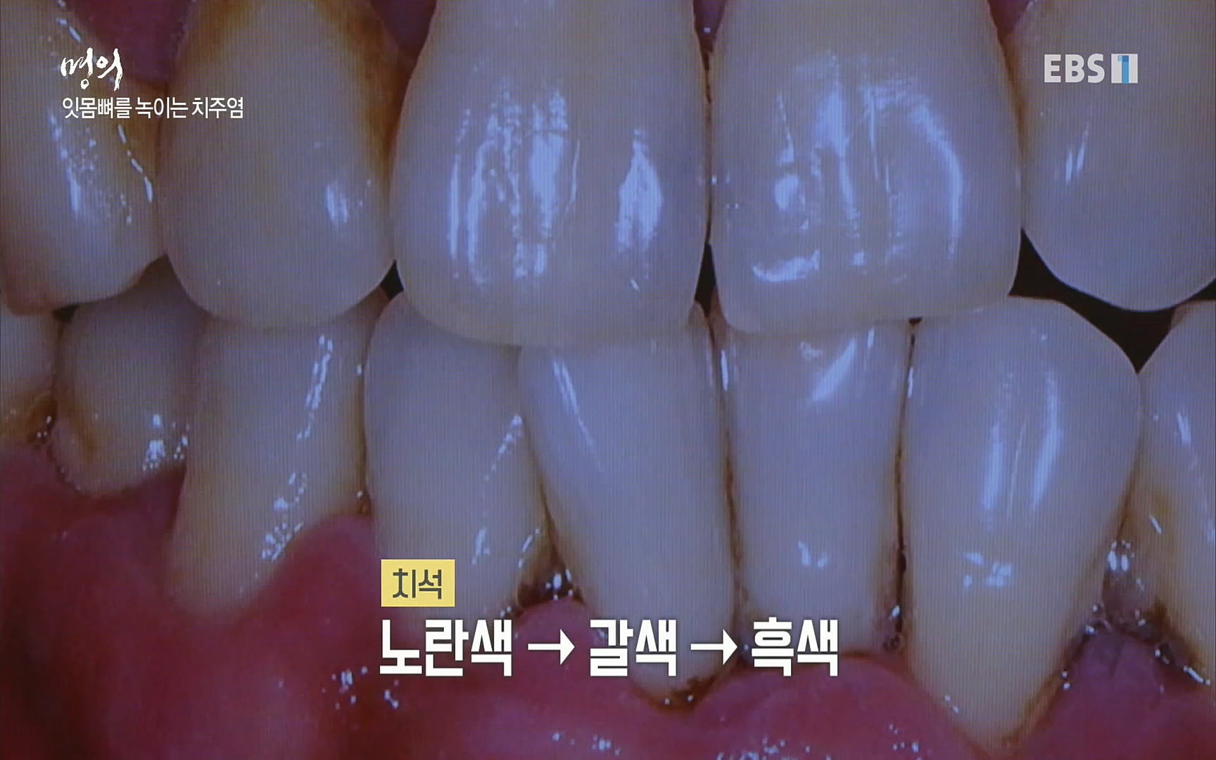EBS 명의 헬스케어 - TV - 교육의 중심 EBS치주염이 코로나로 소홀해진 구강관리가 치아를 더 망가트리고 위험하게 만들며, 증상이 없기 때문에 특히 더 조심하고 치은염 단계에서 진행되지 않도록 예방해야한다 정의원 교수님과 치_20220505_151709.400.jpg