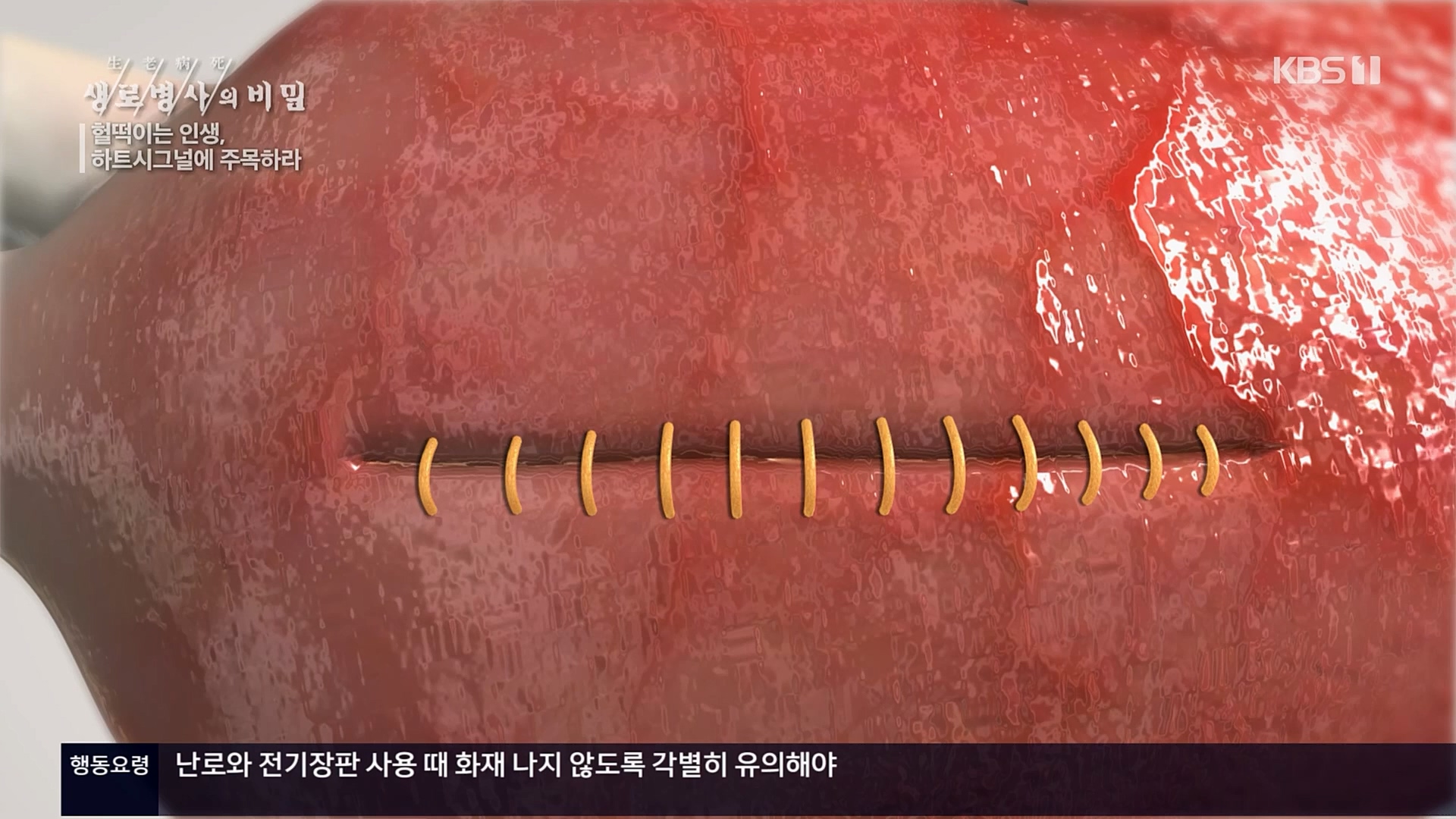 생로병사의 비밀.E853.230125p.H264-F1RST.mp4_20230210_203714.589.jpg