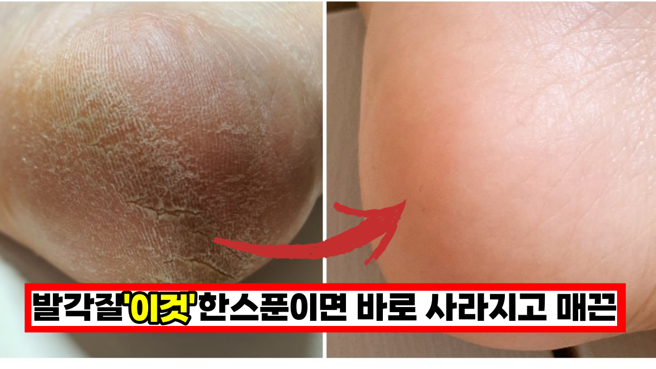  발각질, '이것' 한스푼만 있으면 바로 사라지고 매끈해 집니다.