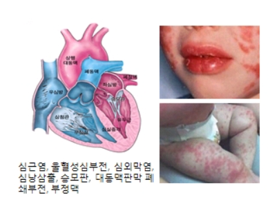  가와사키병 원인/증상/치료 알아보기