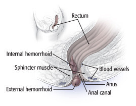  삶의 질을 떨어드리는 말하기 곤란한 질병 치질, 원인 및 증상, 치료방법에 대해 알아봅니다.
