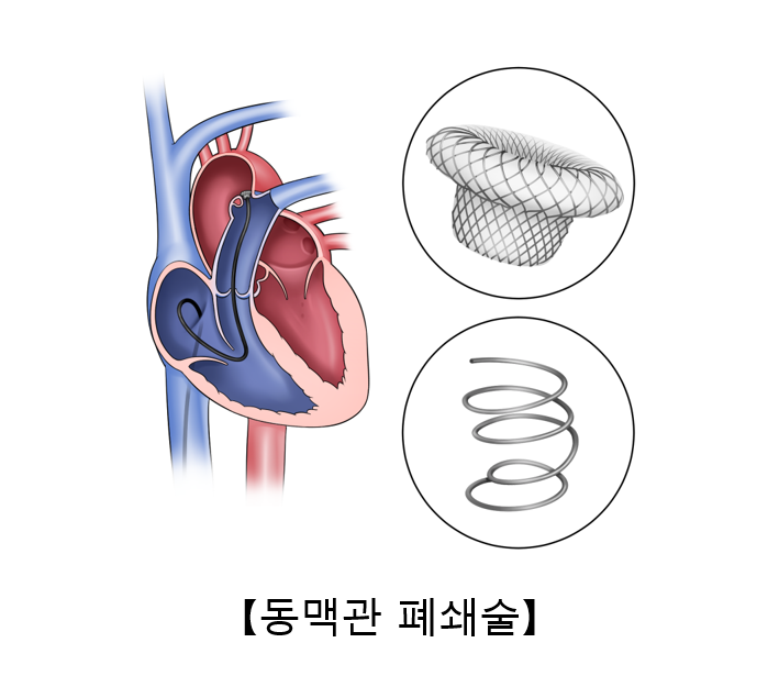 동맥관 개존증