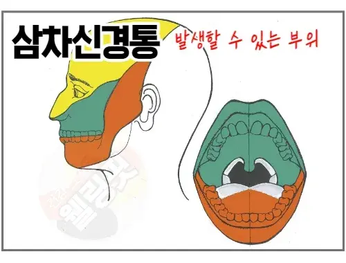 삼차신경통이-있을-때도-치통과-같은-통증이-발생합니다.