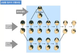 탈모 진행과정