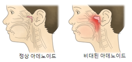  편도염 빨리 낫는 법/증상/원인