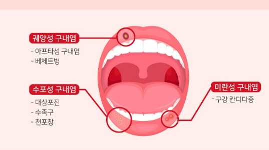 입안 헐었을때 대처방법 알아보기