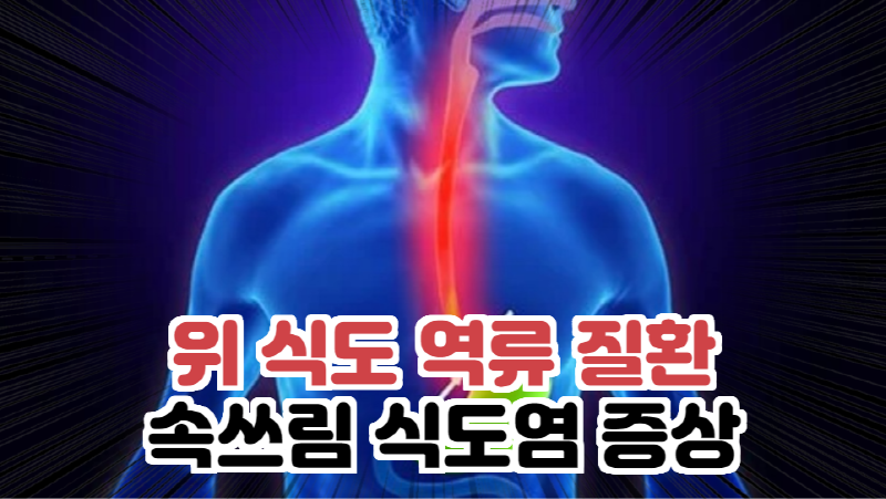  위 식도 역류 질환 속쓰림 식도염 증상 모든 것