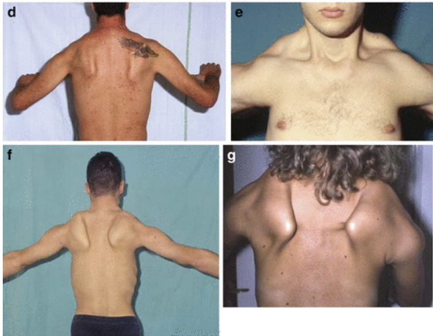 Facioscapulohumeral muscular dystrophy 증상 예시