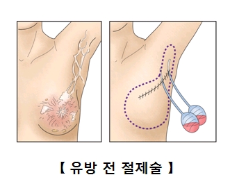 유방 이미지