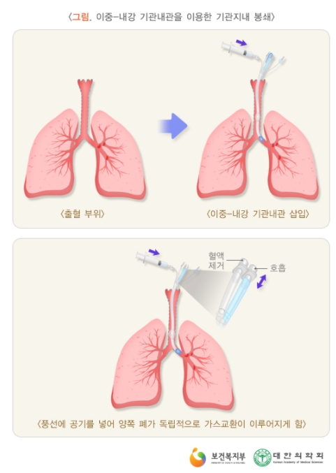 각혈3