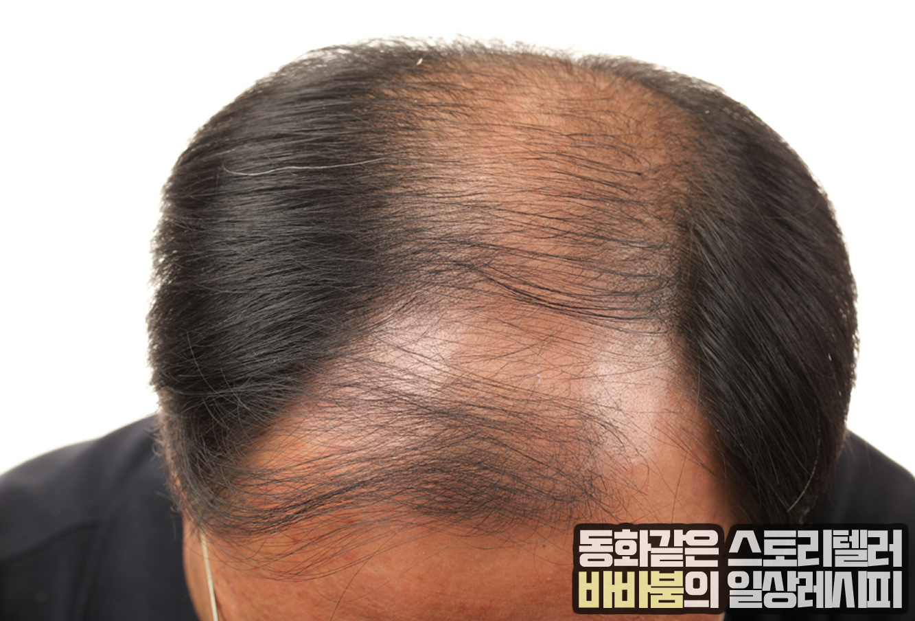  대머리 되진 않을까? 이렇게 하면 걱정 예방 끝!