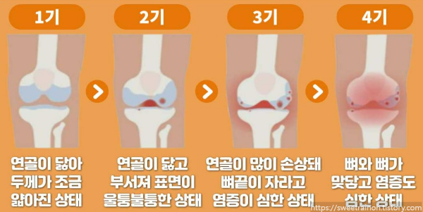 무릎질환-단계별-사진