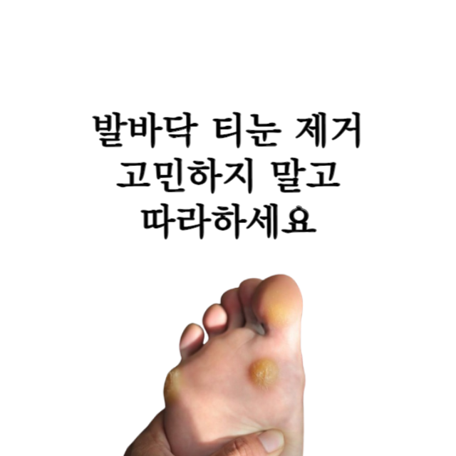 발바닥-티눈-제거-없애는법