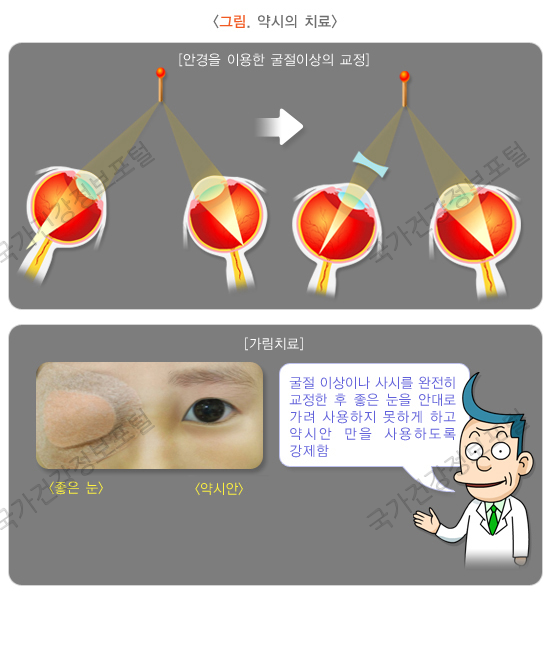 약시 치료