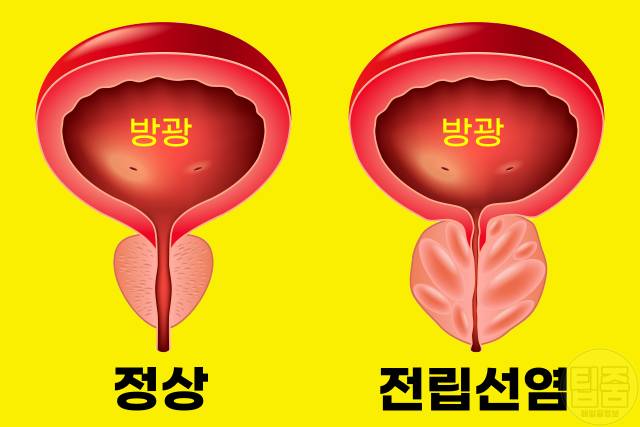 소변 볼때 따가움 따끔 따가워요 전립선염