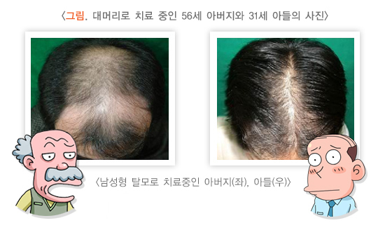  남성형 탈모 증상과 예방 및 치료