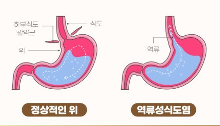  역류성 식도염 흉통 위치와 그 외의 역류성 식도염 증상