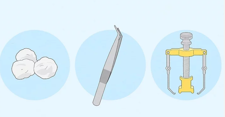 내성 발톱 치료 기구