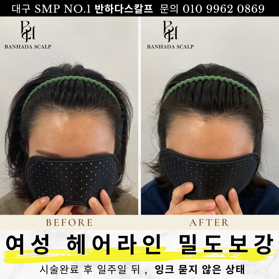 대구 헤어라인교정, 헤어라인반영구, 1
