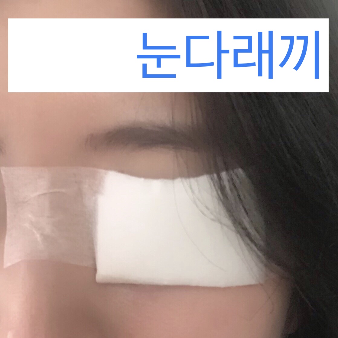  눈다래끼 째기, 눈다래끼 치료, 눈다래끼 제거 후 주의사항
